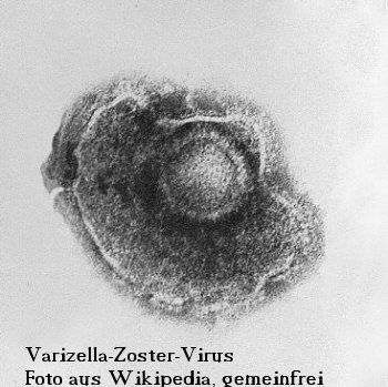 Der Varizella-Zoster-Virus